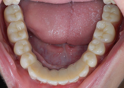 Implantatkrone Implantatkrone