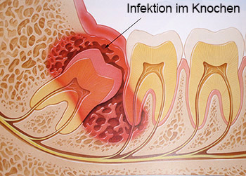 Infektion im Knochen