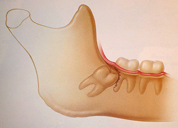 Weisheitszahn